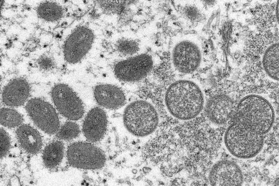 This electron micrograph provided by the Centers for Disease Control and Prevention shows mature oval-shaped monkeypox viruses, left, and immature spherical virions, right, obtained from a human skin sample associated with the 2003 prairie dog outbreak.